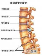 腰椎间盘膨出怎么医治