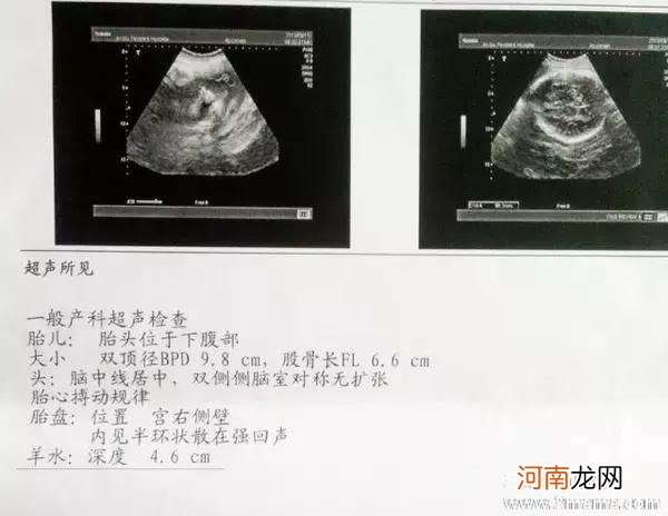 羊水四个象限标准值