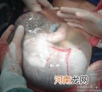 羊水少孩子出生健康不