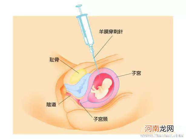 做羊水穿刺前能吃饭吗