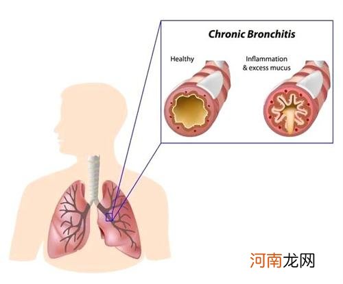 支气管炎干咳吃什么药