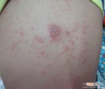孕晚期患湿疹用什么药