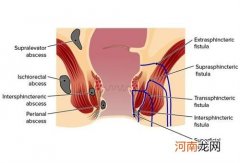 怎么样治盆腔脓肿