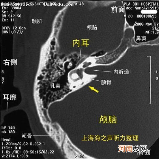 新生儿大前庭导水管综合征 什么是大前庭水管综合征