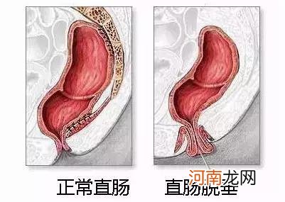 肛门有个软软的肉疙瘩