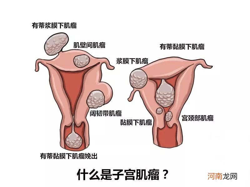 子宫肌瘤痛是什么原因引起的