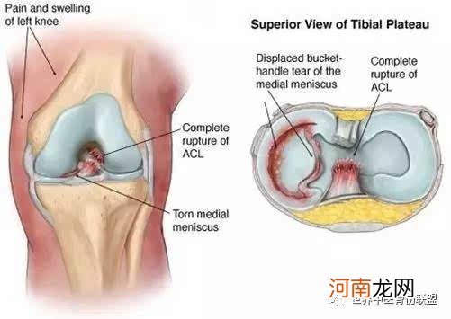 半月板三度损伤能自愈吗