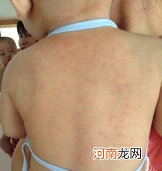 孩子起痱子怎么办？夏季宝宝出痱子 试试中药水擦身