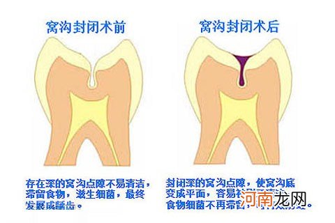 儿童窝沟封闭什么时间做好？孩子防蛀牙可做窝沟封闭