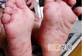 宝宝手足口病不必住院的5种情况