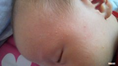 痱子和湿疹的区别 0—1岁宝宝痱子和湿疹的区别
