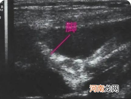 怀孕1-9个月胎儿的样子 怀孕八个月胎儿彩超图