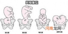 胎位检查可以避免难产