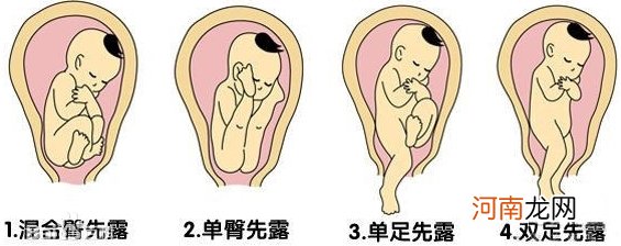胎儿臀位能顺产吗？胎儿臀位的分娩方式