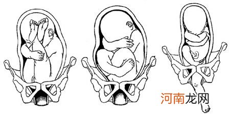 正确纠正胎位异常 降低胎儿死亡率