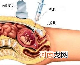 准妈妈需要做羊水诊断