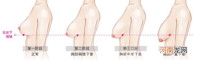 产妇防止乳房下垂做到5个重点