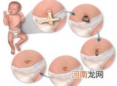 新生儿脐带护理 5种异常情况的处理方法