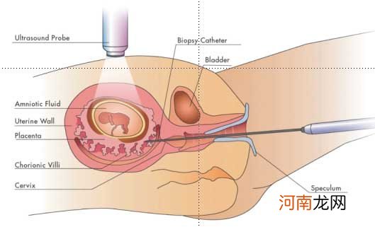 具体什么是妊娠早期绒毛活检