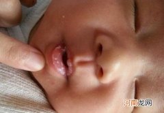 婴儿鹅口疮图片 症状和治疗方法