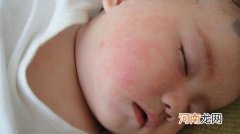 什么是幼儿急疹 幼儿急疹的护理方法