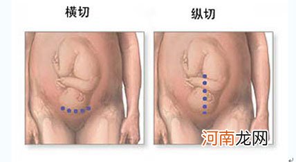 剖宫产不利于宝宝免疫发育