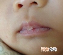 新生儿嘴唇起泡 是用力吸吮乳头或奶嘴造成的