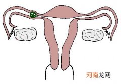 宫外孕的测试及其注意事项