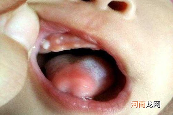 婴儿出牙前的牙包图片 有这几个症状表示快出牙了