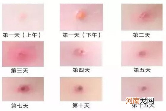 小孩长水痘怎么办 四点护理注意要牢记