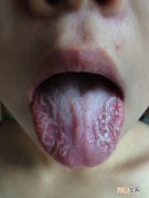 小孩草莓舌舌苔厚是怎么回事