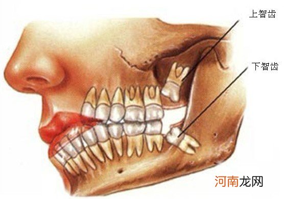 孕前要拔“智慧牙” 为什么