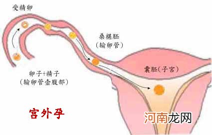 哪些女性要提防宫外孕