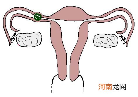 可怕! 八类女性容易宫外孕