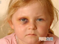 婴幼儿眼部外伤家庭急救小常识