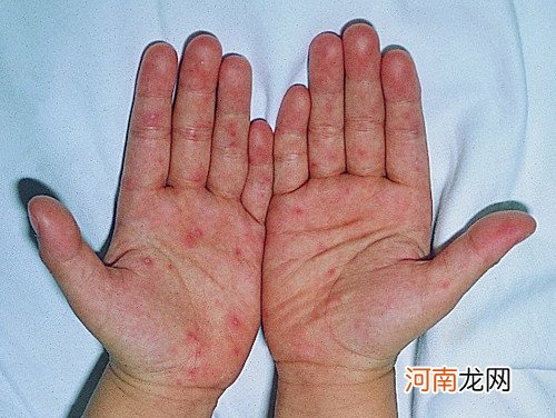 手足口病防治知识 如何预防手足口病的发生