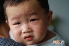 北京一大厦暴发麻疹疫情 儿童需预防