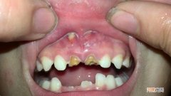 孩子乳牙龋齿 该不该补牙