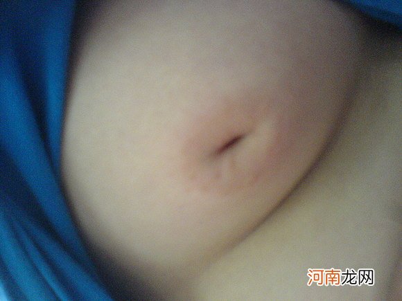 孕前解决乳头凹陷有妙招