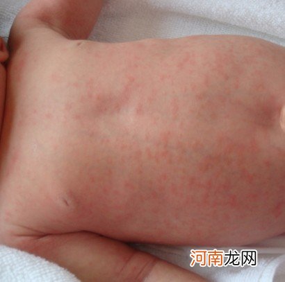 婴儿反复生红疹不是好现象