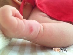 宝宝被蚊子咬了怎么办