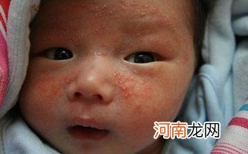 冬季宝宝湿疹防护方案