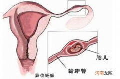 宫外孕手术后要如何调理身体