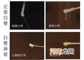 女性白带发黄会影响怀孕吗