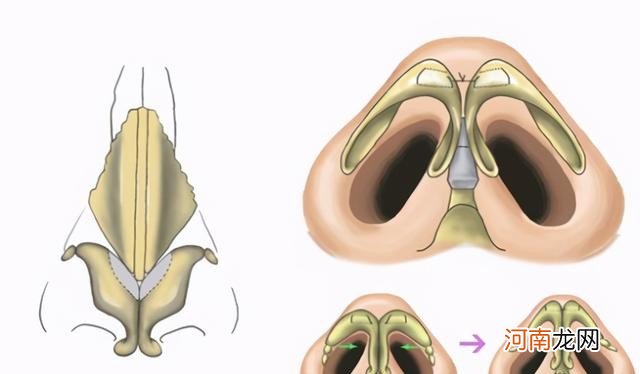 鼻头肥厚有哪些术式可以改善 肥厚鼻尖矫正术