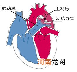 您听说过动脉导管未闭这种病吗