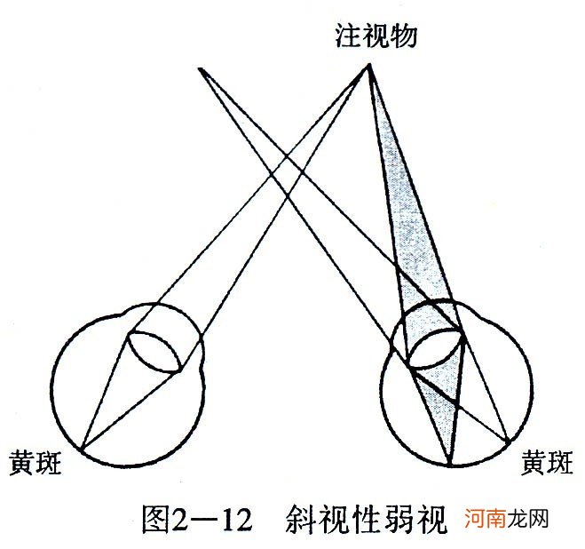 弱视的分类