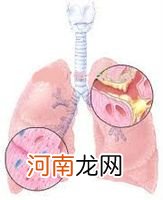 毛细支气管炎临床表现