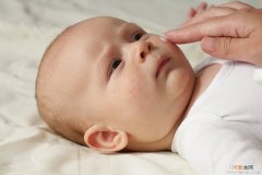 冬季宝宝也患湿疹 纯母乳喂养可预防湿疹