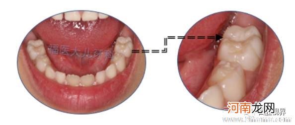 宝宝乳牙早掉危害大 如何预防？